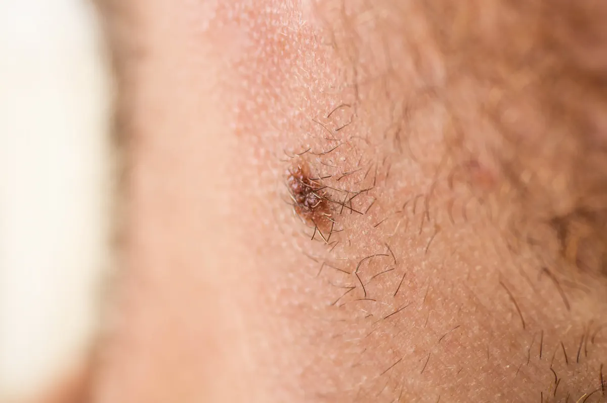 poils incarnés sur les jambes