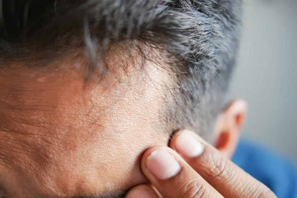 Un homme qui souffre de migraines urticaire